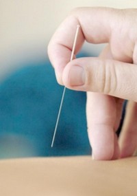 acupuncture